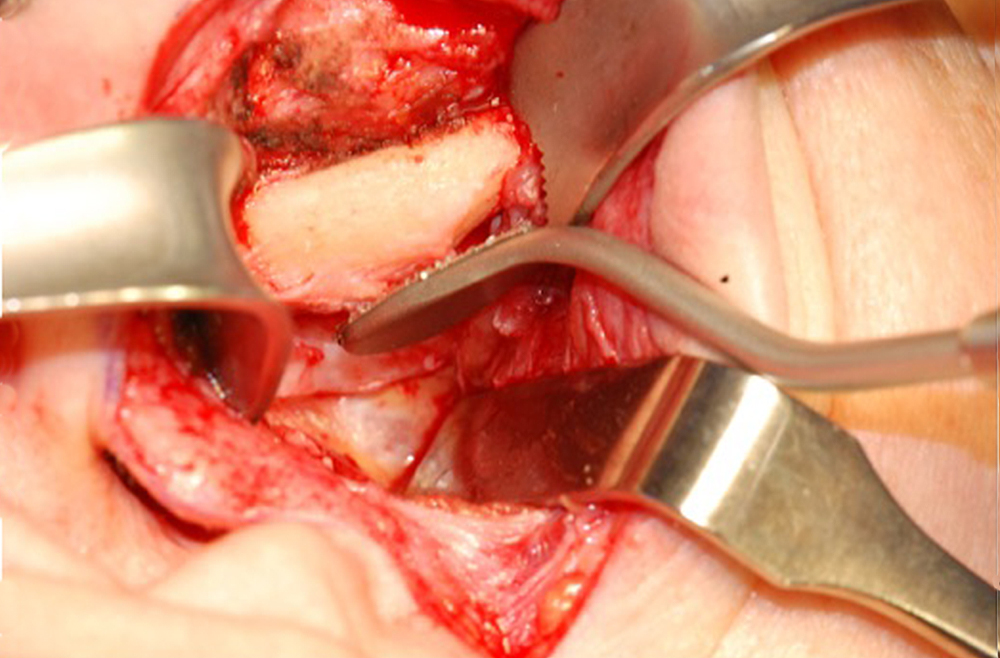 Image demonstrating the rasp during TMJ surgery.
